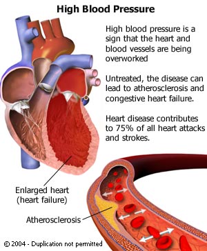 high blood pressure damage
