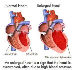 illustration of the effects of hypertension leading to enlarged heart