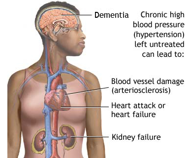 Effects of untreated hypertension
